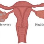 Polycystic Ovarian Disease (PCOD),मधुमेह, उच्च रक्तदाब याप्रमाणेच बदलत्या जीवन शैलीमुळे होणारा स्त्रियांमधील सामान्य आजार…..